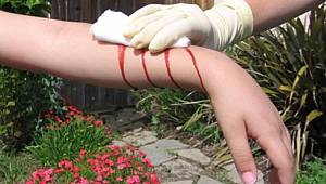 Nedensiz kanamalar hemofili belirtisi olabilir