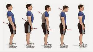 Skolyozu fark etmek mümkün