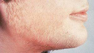 Polikistik Over Sendromu Savaşçısı 10 Besin