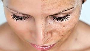 Yaz aylarında cilt lekelerine dikkat!