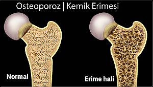 Önlemleri alın, kemik erimesini önleyin