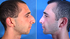 Burun estetiği kişiye özeldir