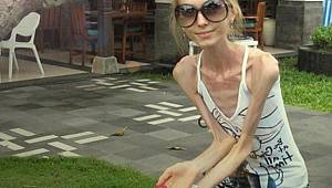 Buna dikkat! Yeme bozukluklarında tedaviye geç kalmayın!