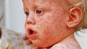 Tüketiciler buna dikakt! Kızamıkta ciddi artış var