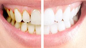 Bu yiyecekler diş sağlığınızı korumaya yardımcı oluyor!