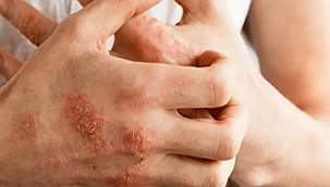 TÜKETİCİLER ÖNEMLİ: Koronavirüse karşı kullanılan el dezenfektanları el egzamasına neden olabilir